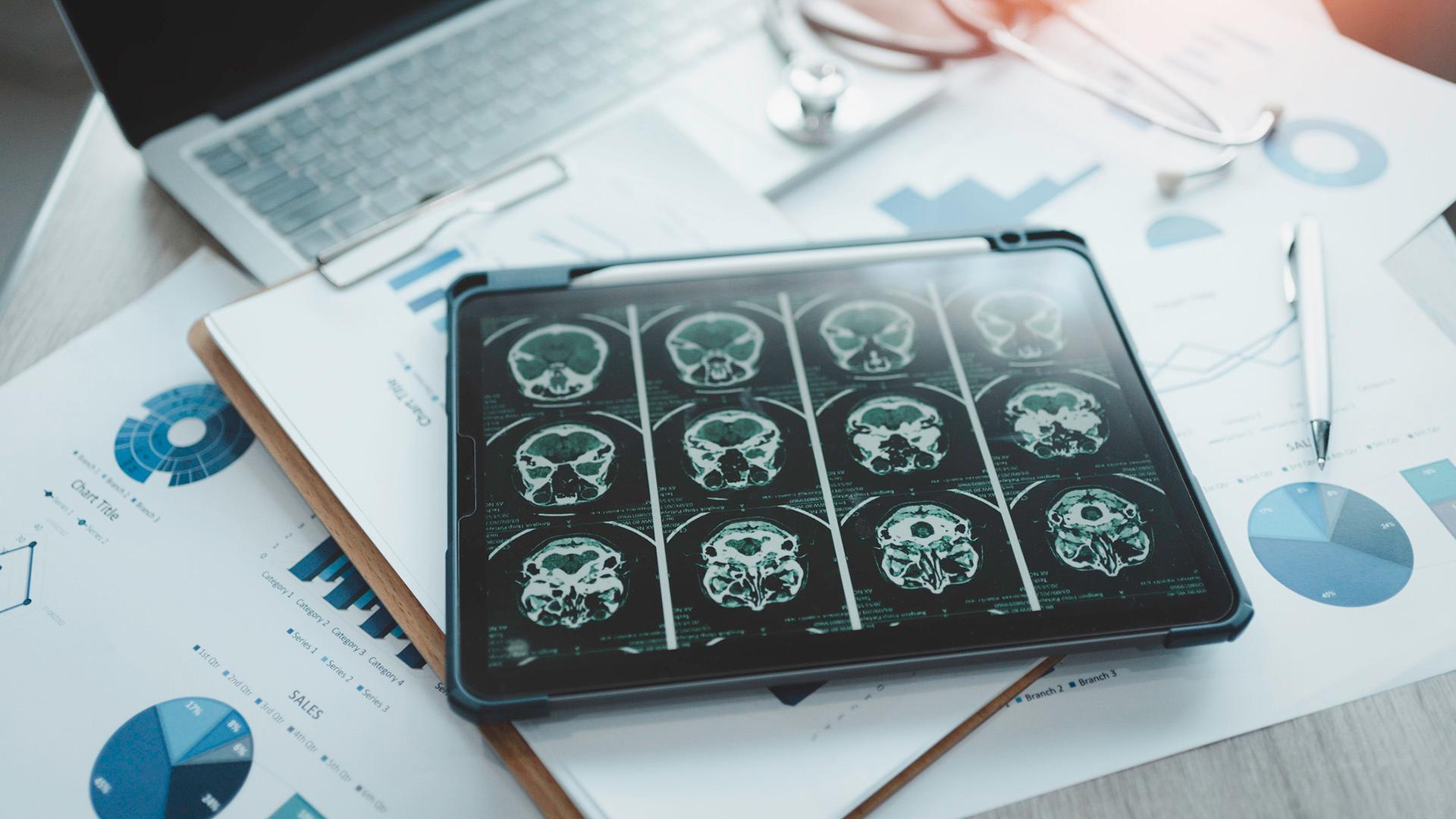 Neurobiological mechanisms underlying agitation in Alzheimer's disease